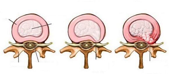 Intervertebrální kýla s cervikální osteochondózou