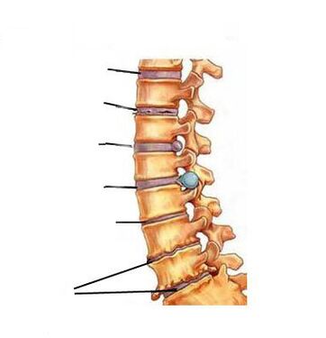Jak se vyvíjí osteochondrosis